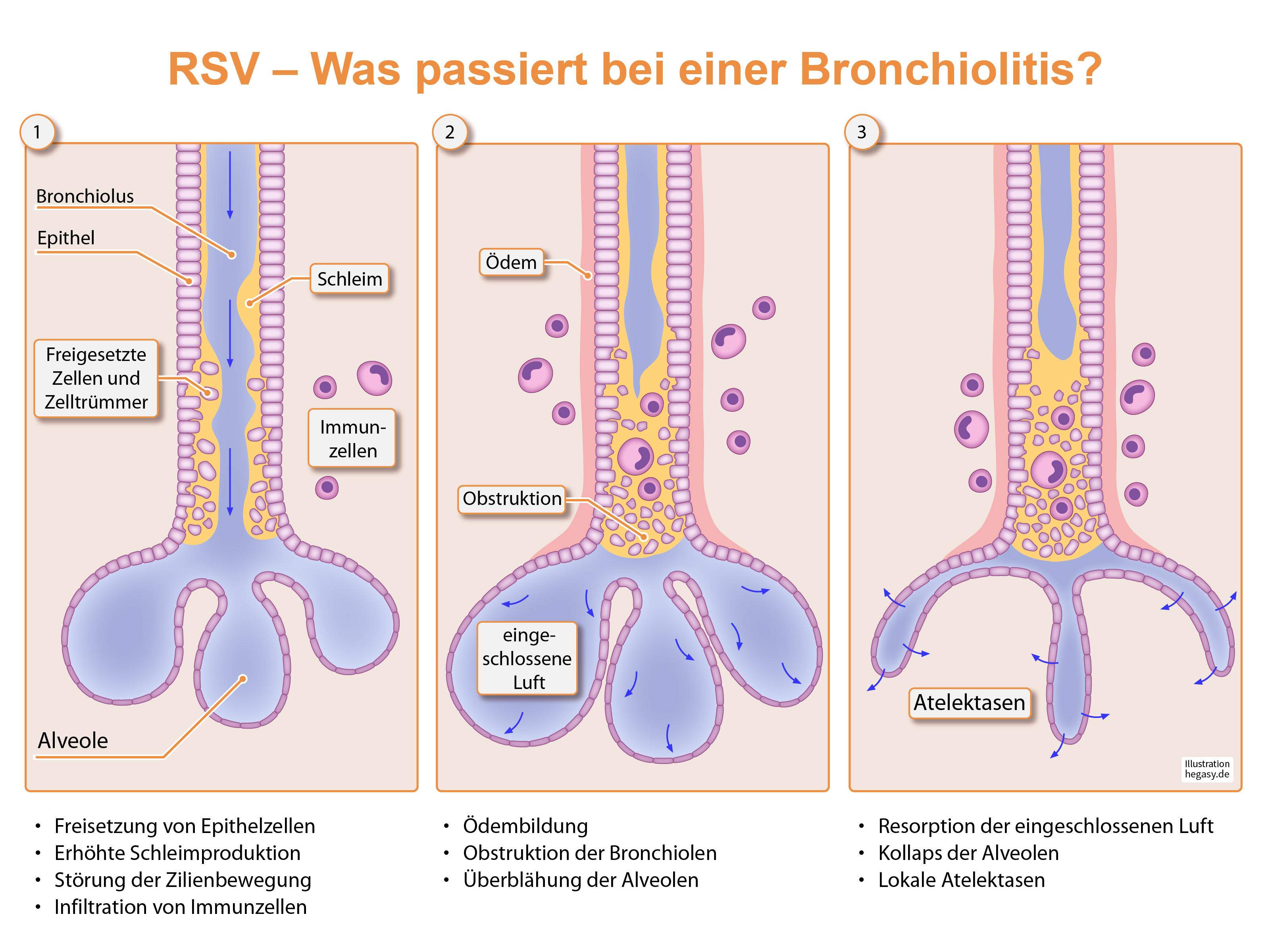 Darstellung Bronchiolitis durch eine RSV Infektion
